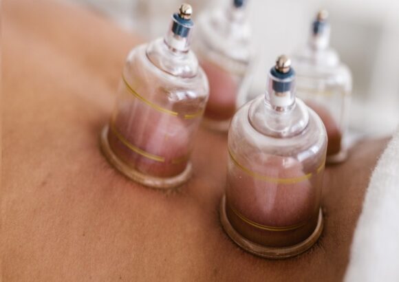 Cupping