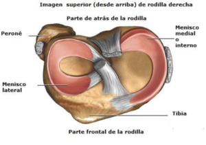 rotura de menisco en la rodilla